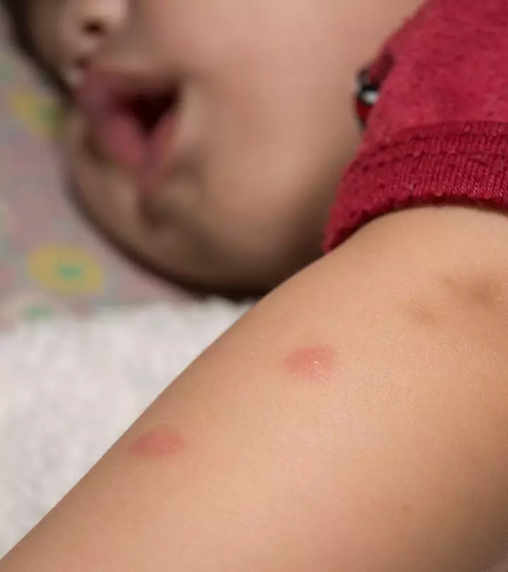 How To Treat And Prevent Mosquito Bites In Babies?