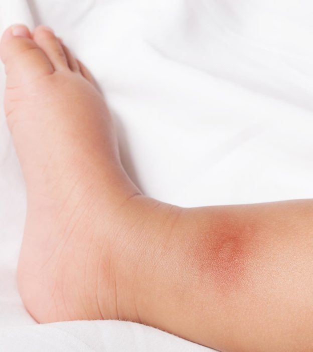 How To Treat Bedbug Bites In Babies?
