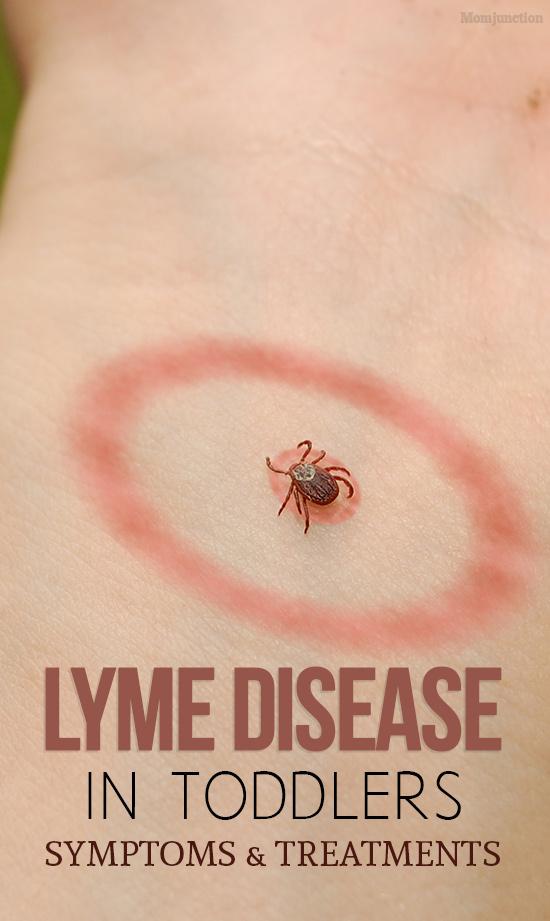 Lyme Disease In Toddlers - Symptoms & Treatments You Should Be Aware Of