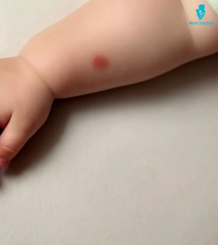 Mosquito-Bites-In-Babies