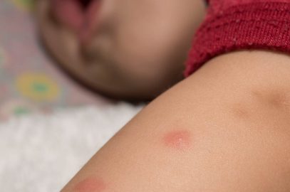 How To Treat And Prevent Mosquito Bites In Babies?