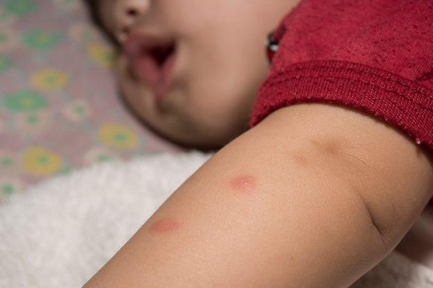 how-to-treat-and-prevent-mosquito-bites-in-babies