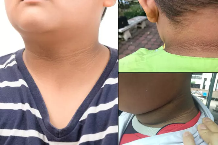 Pictures of acanthosis nigricans in kids