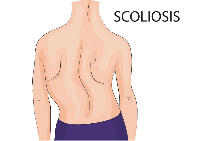 Scoliosis can cause back labor