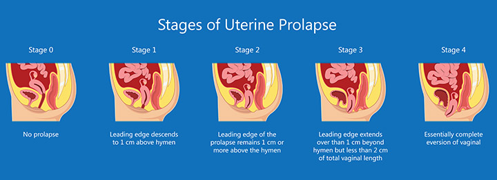 Stages of uterine prolapse during pregnancy
