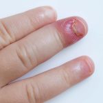 Staph Infection In Toddlers – Everything You Need To Know