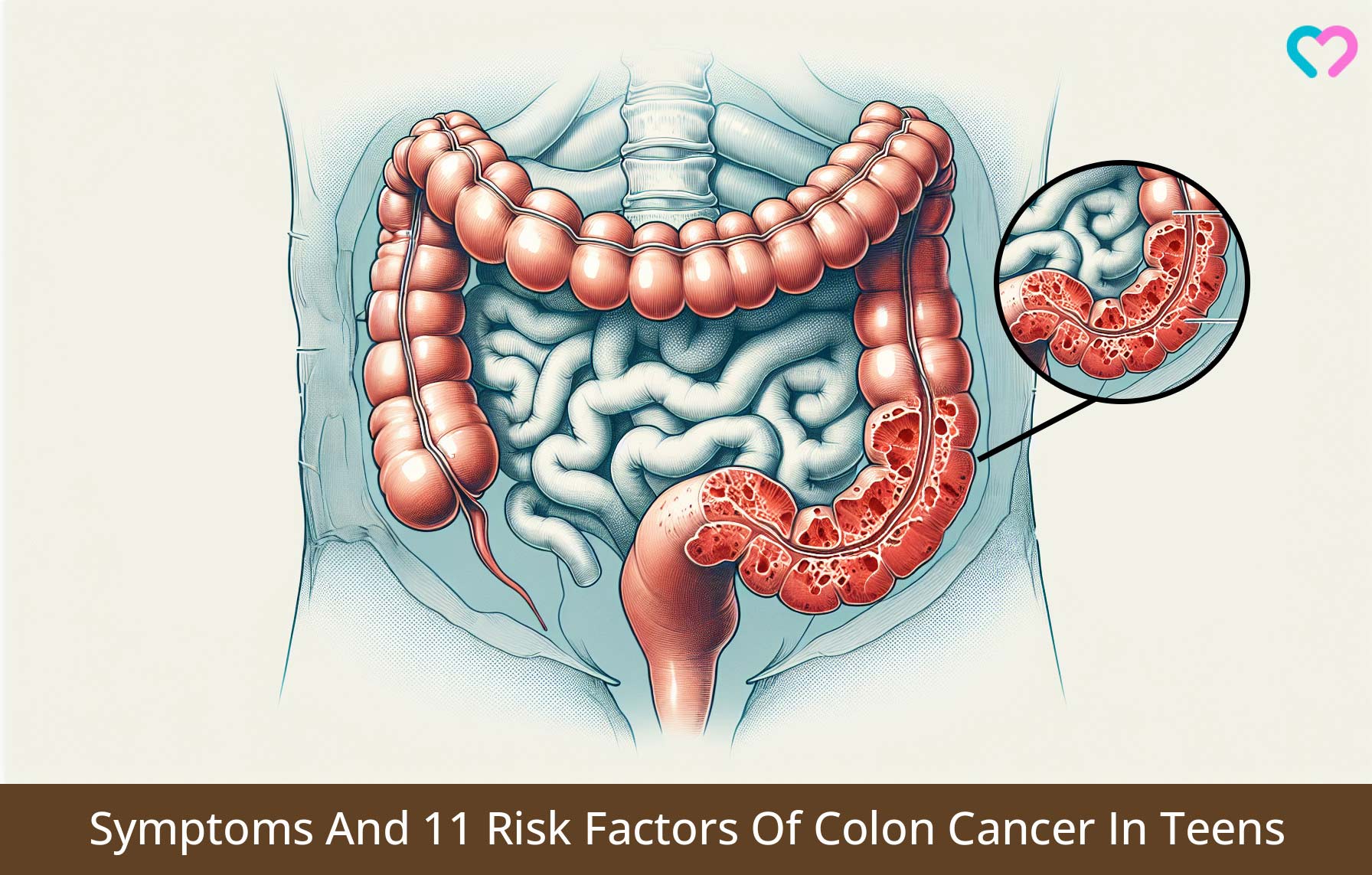 Symptoms And 11 Risk Factors Of Colon Cancer In Teens_illustration