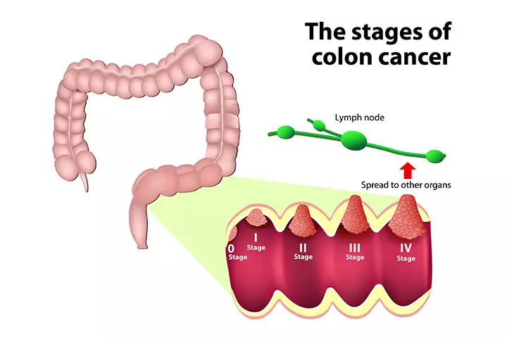Stages of colon cancer in teens