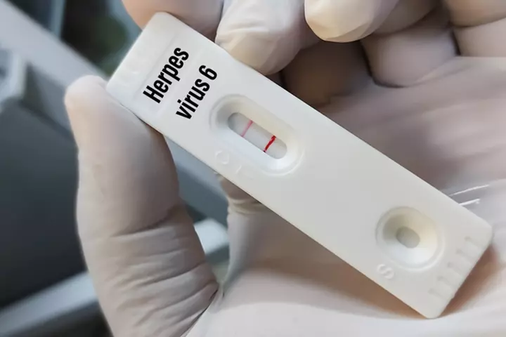 The human herpesvirus-6 causes roseola in toddlers