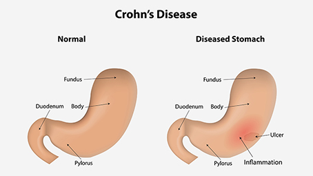 7 Unexpected Symptoms Of Crohn's Disease During Pregnancy