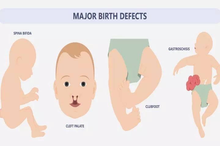Bicornuate uterus may lead to fetal complications