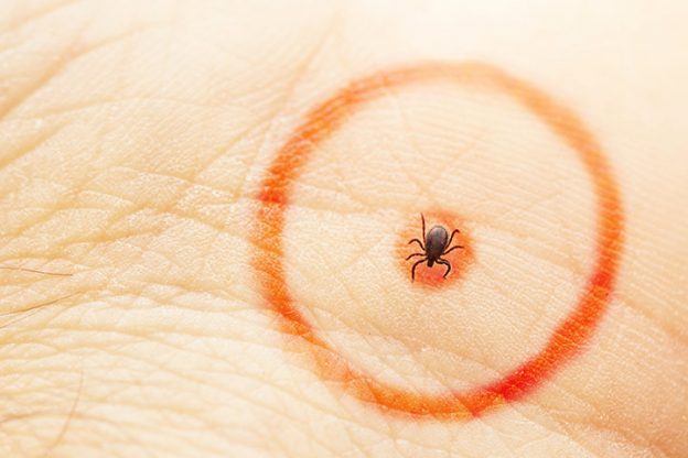Lyme Disease During Pregnancy - Symptoms, Diagnosis And Treatment