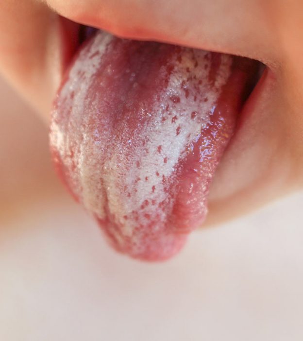 What Causes Thrush In Children And How To Treat It