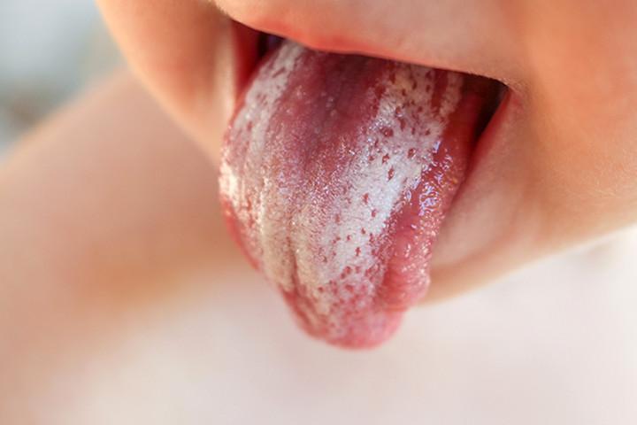 Thrush In Children: Symptoms, Causes 