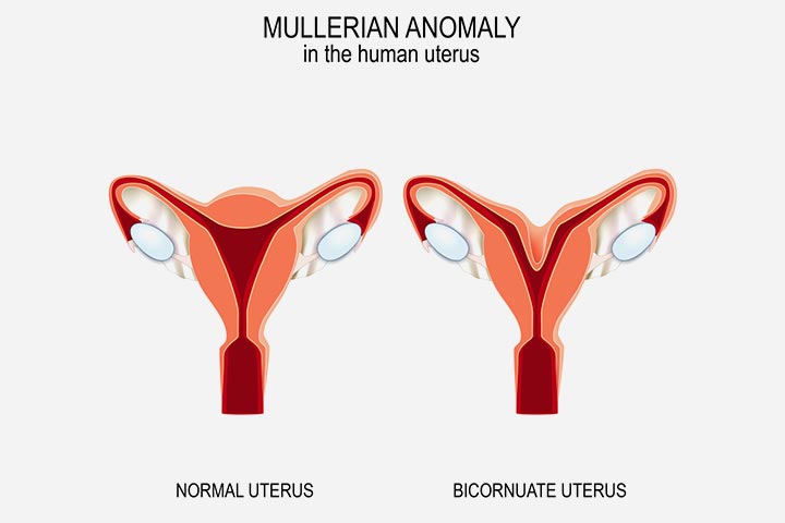 Uterine anomalies are due to abnormal gene expression