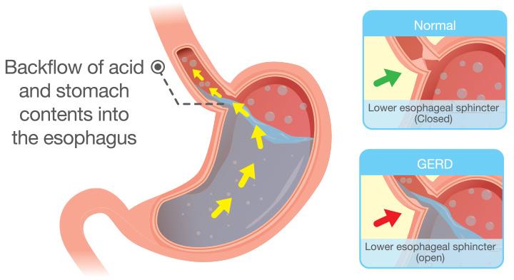 Why do i get hiccups with acid reflux