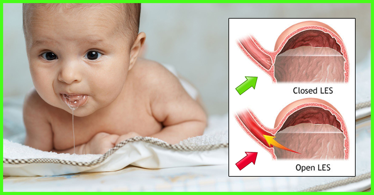 Acid reflux in babies only at night