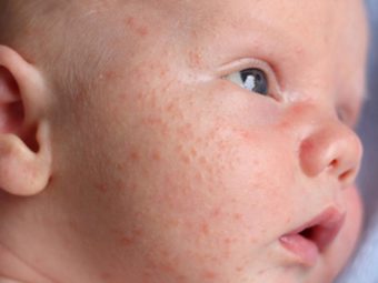 Baby Acne: Causes, Symptoms And How To Get Rid Of It