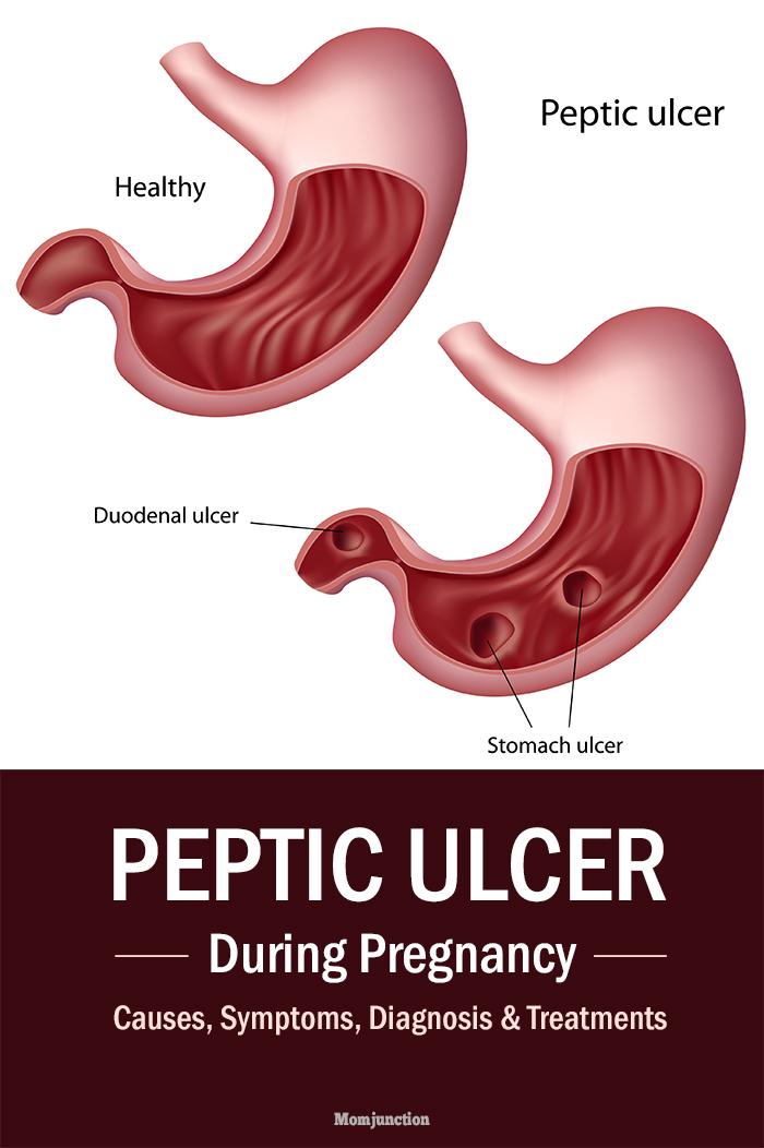 peptic-stomach-ulcer-during-pregnancy-causes-symptoms-diagnosis