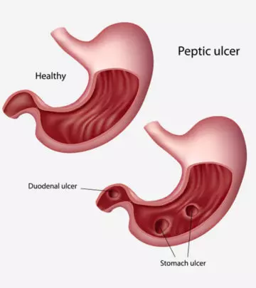 Stomach Ulcer During Pregnancy - Causes, Symptoms, Diagnosis & Treatments