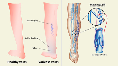 Varicose Veins After Pregnancy - 3 Causes, 8 Symptoms & 4 Treatments You Should Be Aware Of