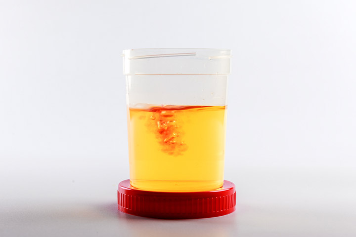 Blood in urine may give a false-positive result