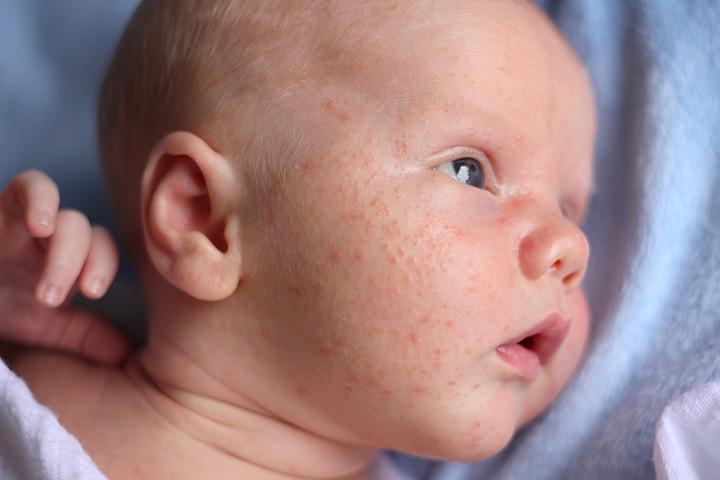 Rash on face of breastfed baby