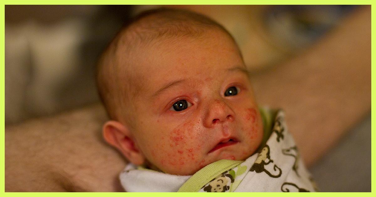 Baby Acne What Causes Them And How You Can Prevent