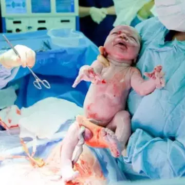 8 Things I Wish Somebody Had Told Me About C-Sections
