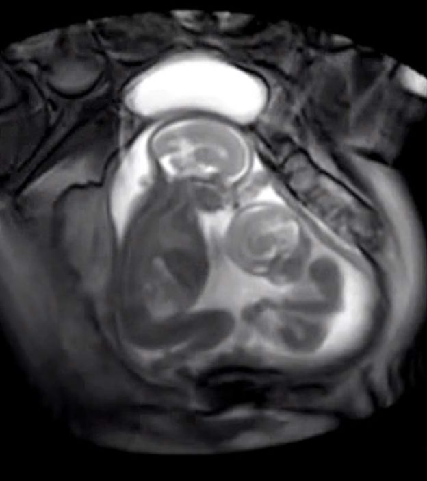 This MRI Scan Of Twin Babies Inside The Womb Is Going Viral. And The Reason Will Leave You Astonished