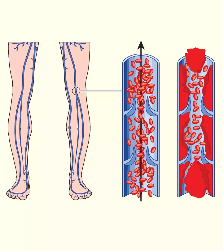 7 Most Common Causes Of Blood Clot During Pregnancy