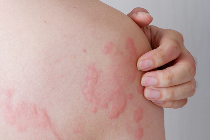 Hives may be stingy or itchy