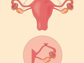 Pregnancy After Tubal Ligation: Signs, Symptoms And Risks
