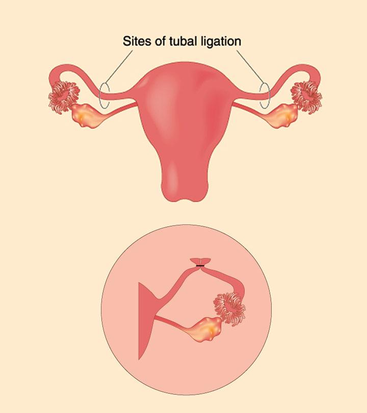 bilateral tubal ligation