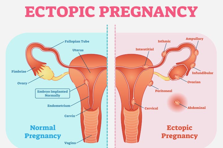 Pregnancy after tubal ligation may be ectopic