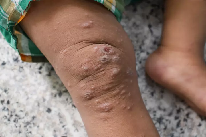 Scabies in kids can transmit rapidly