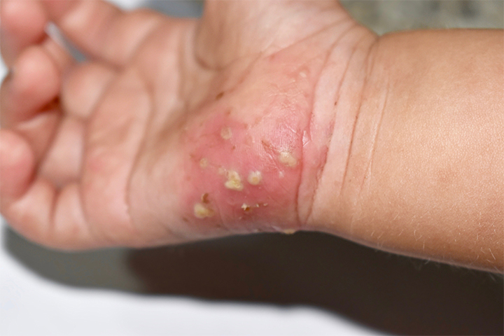 Scabies lesions may be seen on wrists 