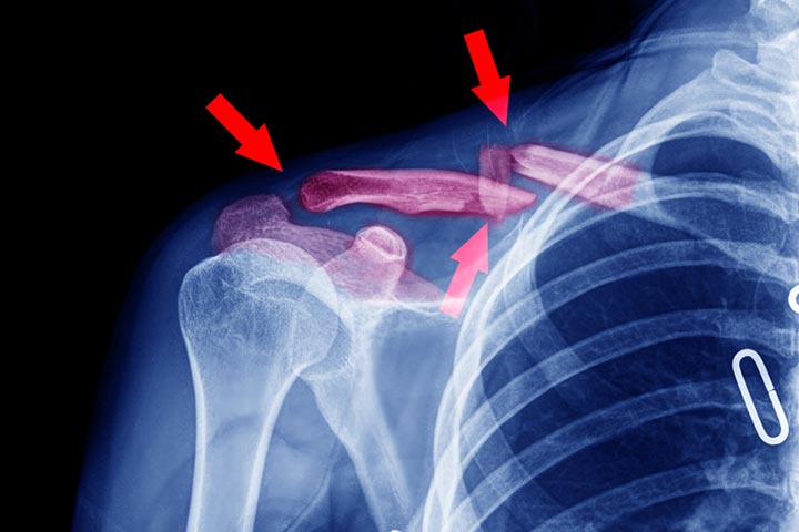 Signs And Symptoms Of Broken Collarbone In Children