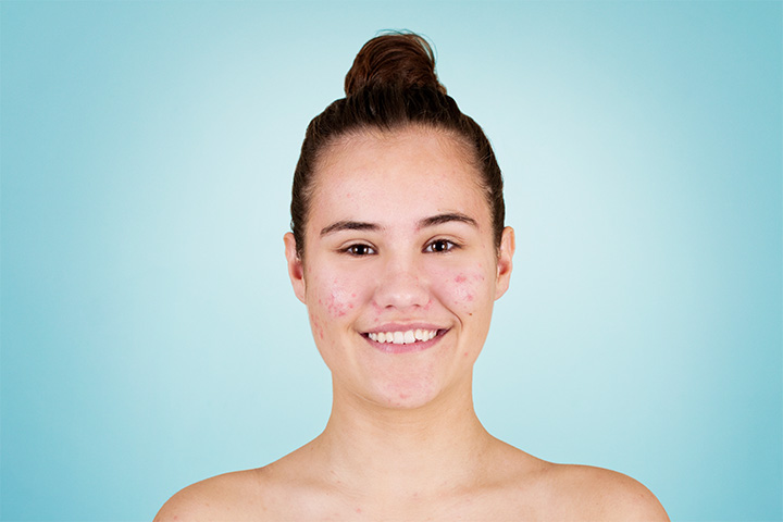 Teens may experience pimples or acne during puberty