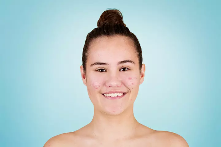Teens may experience pimples or acne during puberty