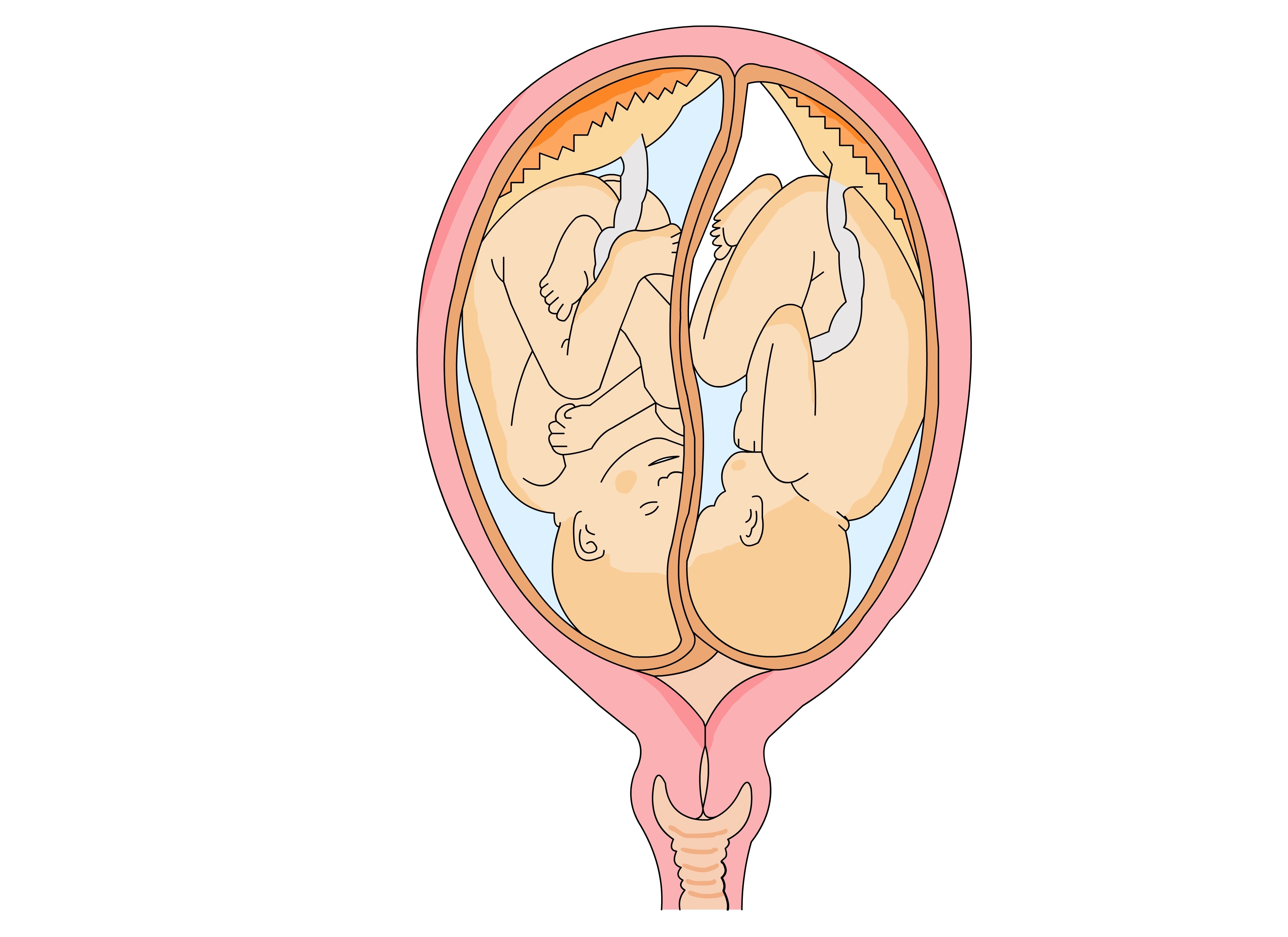 12 Common Complications Of Twin Pregnancy
