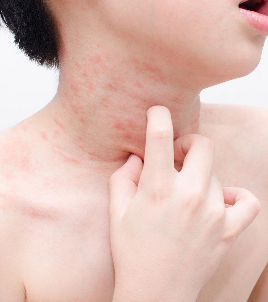 Skin Rashes In Children Causes Treatment And Prevention