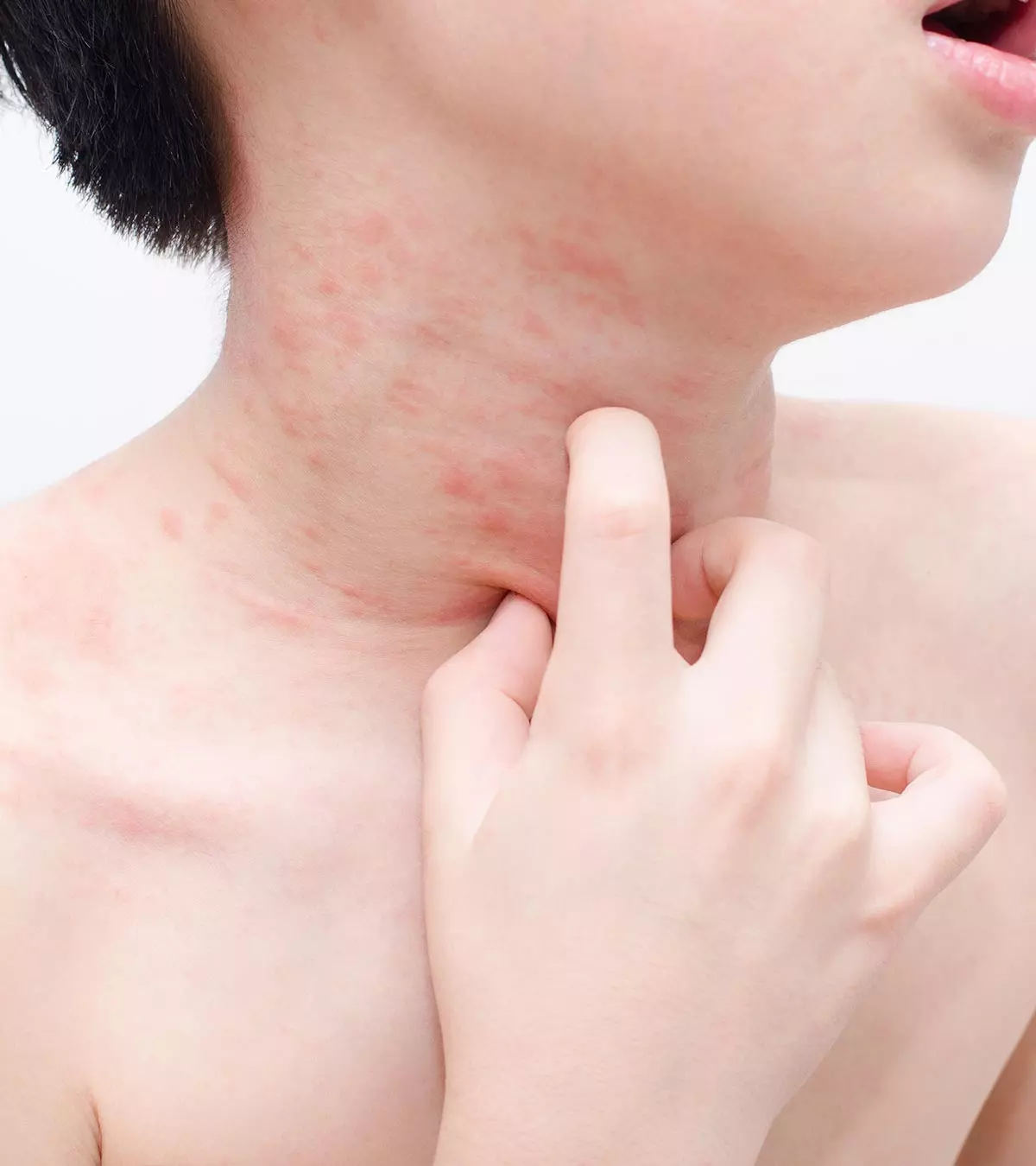 12 Common Skin Rashes In Children And Their Treatments