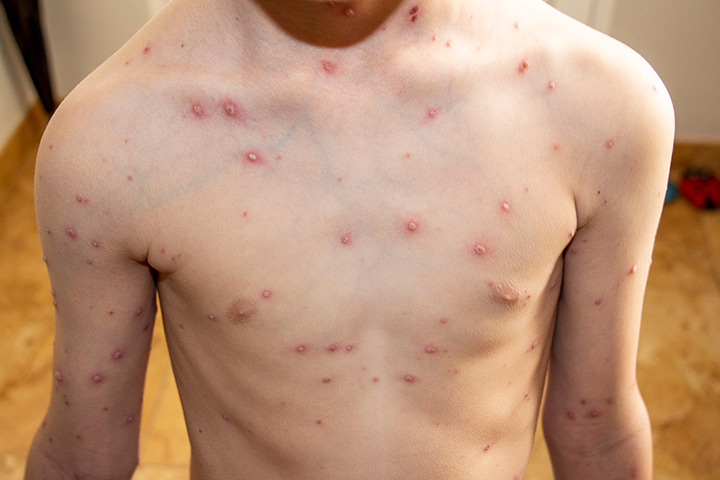 Chickenpox, skin rash in children