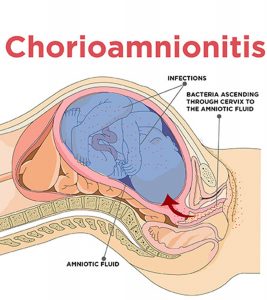 Chorioamnionitis: What Is It And How Is It Treated
