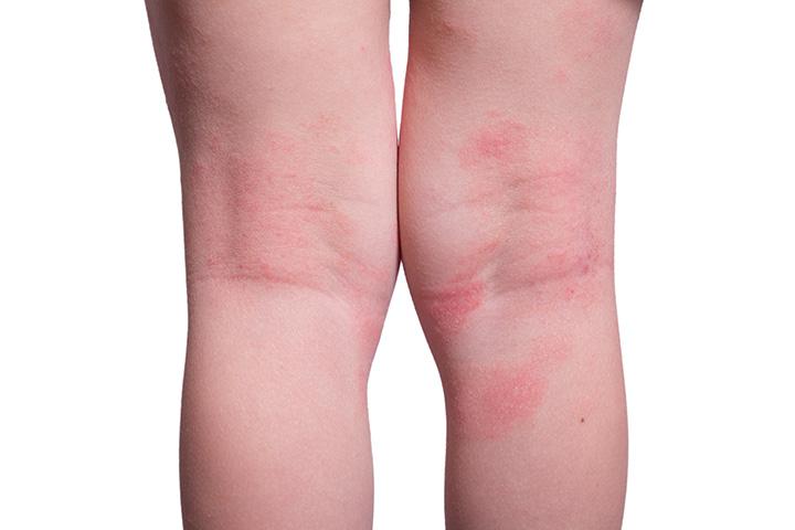 heat rash knees