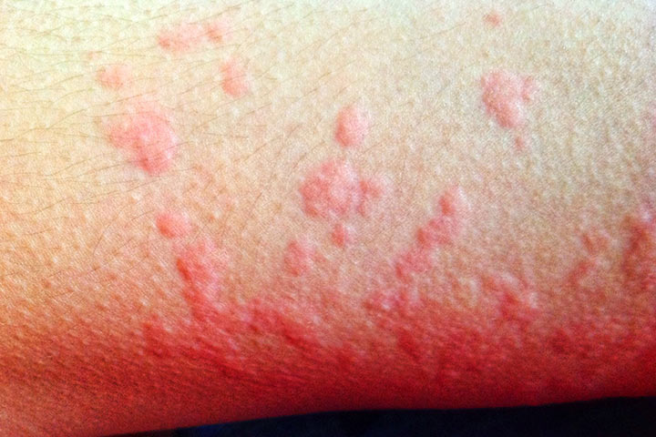 Erythema Multiforme skin rash in children