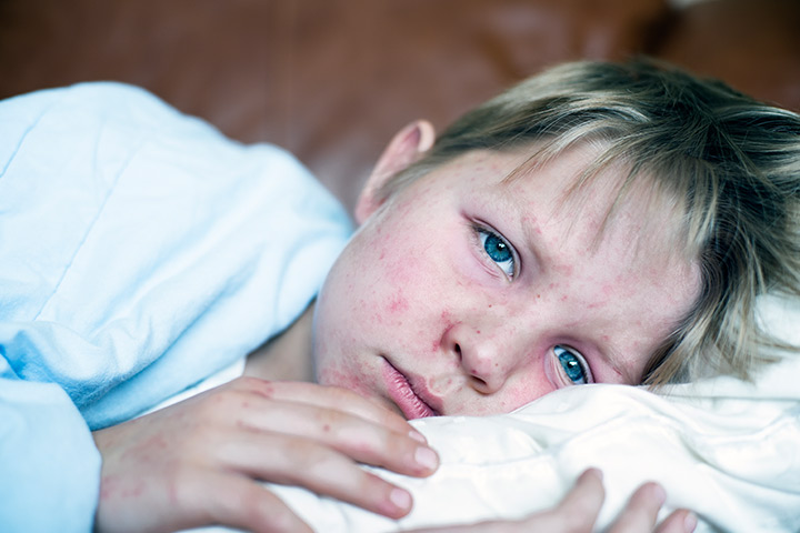 Rubella or German measles, skin rash in children