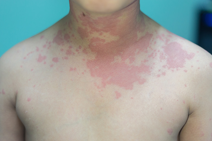 Hives skin rash in children