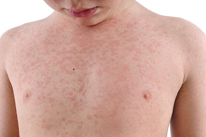 Measles, skin rash in children